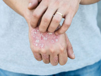 علت بیماری پوستی درماتوفیتوز (قارچ پوستی) + بهترین راه درمان