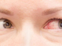 عفونت چشم و راههای ساده پیشگیری از آن