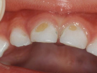 هر آنچه که از رویش تا پوسیدگی دندان باید بدانید