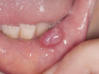 موکوسل دهانی : درمان قطعی کیست لب با طب سنتی