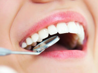 تفاوت کامپوزیت با لمینت دندان | مزیت و معایب هر کدام