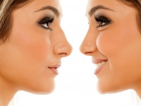 جراحی بینی را برای چه باید انجام بدیم و باید چه نکاتی رو لحاظ کنیم ؟