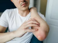 علائم حساسیت و آلرژی به ملون و خربزه و درمان این عارضه در طب سنتی