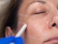 عوارض جراحی لیفت صورت : آنچه کلینیک‌ ها به شما نمی گویند !