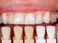 برای زیبایی دندان چه کار کنیم؟ لمینت دندان یا کامپوزیت دندان