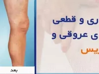 روش‌های درمان واریس در افراد مختلف