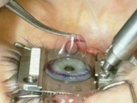 آیا عمل لیزیک چشم مفید است؟