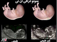 غربالگری و سلامت جنین در چه ماهی انجام می شود؟