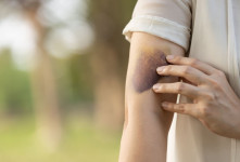 علت کبودی و سیاهی طولانی مدت پوست