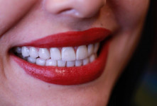 ضرورت انجام پالیش دندان پس از کامپوزیت چقدر است؟