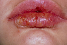 نشانه و علت عفونت لب بعد از تزریق ژل