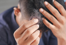 آلوپسی | بهترین و سریع ترین راه بهبود و درمان آلوپسی آره آتا (طاسی یا ریزش مو)