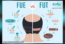 آشنایی با کاشت مو به روش های SUT و FUE، کدام یک بهتر است؟