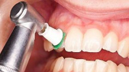 ویدیو مراحل  اسکیلینگ و جرم گیری دندان در دندانپزشکی‌ها