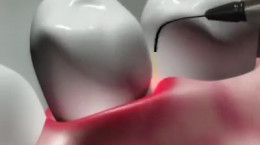 آخرین تکنولوژی روز دنیا برای درمان بیماری‌‌های لثه و دندان
