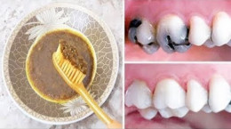 سریعترین راه جرم گیری و سفید کردن دندان‌های زرد در خانه