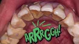 ویدیو جرم گیری دندان در دندانپزشکی