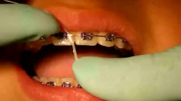 آموزش زدن نخ دندان ارتودنسی