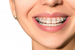 بهترین سن برای انجام ارتودنسی دندان چه سنی است؟