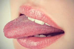 ۱۰ درمان مناسب سوختگی زبان به علت خوردن غذای داغ