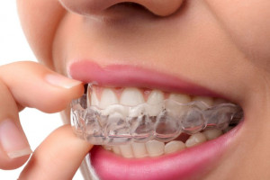 ارتودنسی نامرئی همه چیز در مورد ارتودنسی نامرئی و فواید آن