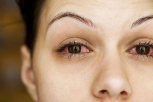 سودوتومور اربیت چشم چیست و چه علائمی دارد؟