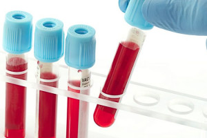 علت بالا و پایین بودن BUN در آزمایش خون