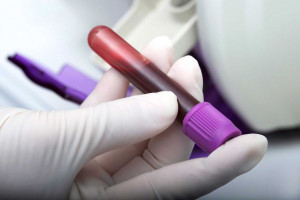 علت بالا و پایین بودن C۱- INH -  C۱EI در آزمایش خون
