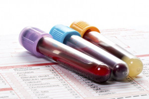 علت بالا و پایین بودن C۳ در آزمایش خون