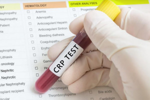 علت بالا و پایین بودن CRP در آزمایش خون 