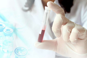 علت بالا و پایین بودن GGT در آزمایش خون 