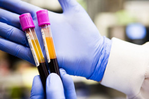 علت مثبت و منفی بودن HBs Ag در آزمایش خون 