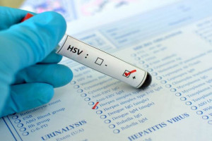 علت مثبت و منفی بودن HSV PCR در آزمایش خون/CSF