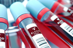 علت بالا و پایین بودن LDH در آزمایش خون 