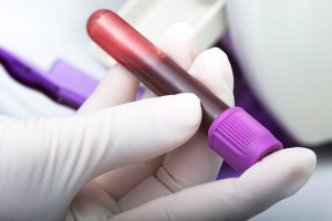 علت مثبت و منفی بودن VZV PCR در آزمایش خون