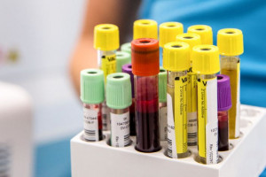 علت مثبت و منفی بودن Toxoplasma gondii PCR در آزمایش خون/CSF