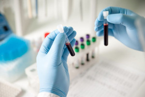 علت بالا و پایین بودن FT۳ در آزمایش خون 