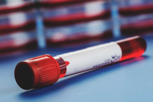 علت مثبت و منفی بودن Hb.S در آزمایش خون 