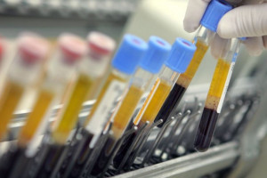علت مثبت و منفی بودن ASCA در آزمایش خون 