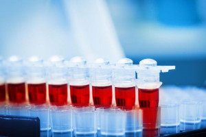 علت مثبت و منفی بودن Double marker or NT Test در آزمایش خون 