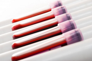 علت مثبت و منفی بودن Quad marker در آزمایش خون