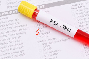 علت بالا و پایین بودن fPSA در آزمایش خون