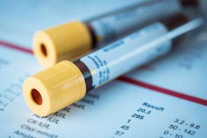 علت بالا و پایین بودن NBT در آزمایش خون