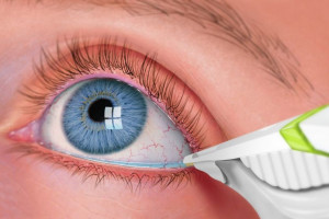 علت مثبت و منفی بودن EYE Discharge در آزمایش ترشحات چشمی