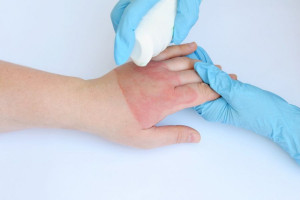 درمان سوختگی : ۱۰ روش خانگی برای درمان سوختگی پوست