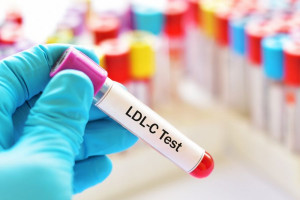 LDL در آزمایش خون : تفسیر کامل کلسترول بد (LDL) در آزمایش چیست ؟
