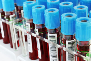 HGB در آزمایش خون | عوامل موثر در کاهش و افزایش هموگلوبین (HGB)