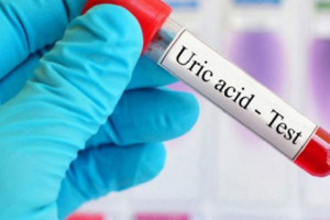 بررسی و تفسیر جواب (Uric Acid) خون