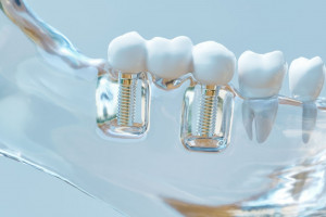 روکش دندان چیست؟ انواع، مزایا و معایب آن