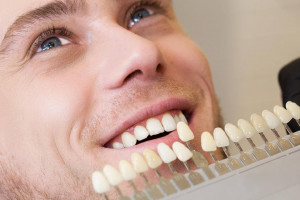 آیا روکش دندان با لمینت دندان فرق دارد؟